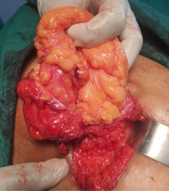 Large Umbilical Hernia and Mesh Repair Before